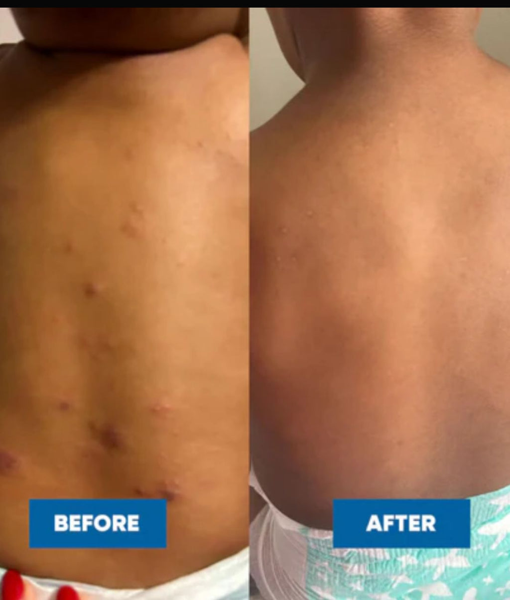 Eczema And Psoriasis Soap for Sensitive Skin Relief